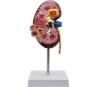 Generico Modello 3D delle Malattie Renali, Modello del Rene, Modello Patologico del Rene con Identificazione Digitale della Posizione Anatomica per Dimostrazione Didattica