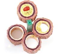Generico Modello di arteria a 4 pezzi, modello di aterosclerosi con accumulo di placca, modello anatomico dei vasi sanguigni umani, modello anatomico per studi medici e aule.