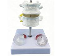 Generico Modello di Colonna Lombare a Due Sezioni - Modello di Lesione della Colonna Lombare Umana, con Nevel Lombari e Midollo Spinale, Anatomia a Grandezza Naturale - per Apprendimento