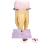 Generico Modello di Denti con Carie - Modello di Dente Ingrandito 3 Volte, Denti con Carie Rimovibili e Nervo Dentale in 6 Parti, Sezione Trasversale del Dente per Dimostrazione