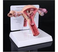 Generico Modello di ovaio dell'utero patologico, Modello di Organo riproduttivo Femminile Modello anatomico di Utero Umano con Scheda espositiva didattica e Base per l'insegnamento