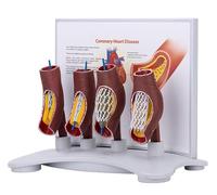 Generico Modello di Stent Coronario Umano, Modello di Stent Vascolare, Modello di Blocco Vascolare, Modello Anatomico di Stent Vascolare, Modello di Dimostrazione di Ingrossamento