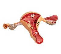 Generico Utero Modello Ovarico Organi Riproduttivi Femminili, Utero Patologico Umano Modello Ovarico, Modello Anatomico, Anatomia Malattia Patologia per l'Insegnamento Dell'apprendimento