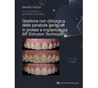 Gestione non chirurgica delle parabole gengivali in protesi e implantologia. MF extrusion technique