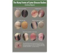 GYQYJPFZM Lyme Disease Prevention Poster Stop the Spread Self Protection Guide Wall-Art Canvas Print for Bedroom Living Room Decor(Unframed,16x24inch(40x60cm))