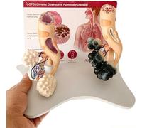 HGAYUBDV Modello di Struttura alveolare ingrandita, Modello di confronto tra Alveoli Fumatori e Alveoli sani con Retro in Inglese, Modello anatomico alveolare Umano for l'insegnamento della Salute.