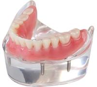 HGJHJJHK Modello di restauro Dentale di overdenture dentali Modello di restauro Dentale con 4 impianti Overdenture Demo di impianti di precisione Inferiore