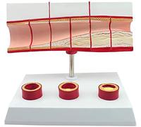 HUIBBGO Modelli Medici, Modello anatomico del processo di trombosi, Modello del colesterolo Cuore-vascolare, Modello anatomico del colesterolo nel Sangue per malattie cardiache, Modelli Me