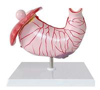HUIBBGO Modello educativo Modello di Anatomia dello Stomaco Modello di gastrite Modello di lesione gastrica Patologia dello Stomaco Ulcera da gastrite Anatomia dell'organo Umano Modello an