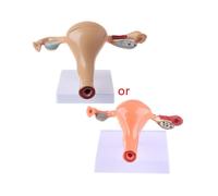 Human Pathological Uterus Ovary Model Anatomical Anatomy Disease Pathology Medic