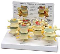 HUOYALU Colonna Lombare Lesione Normale Combinazione Modello Modello della Colonna vertebrale Anatomia del Corpo Umano delle Condizioni delle Vertebre a Quattro stadi