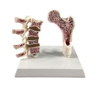 Il Modello di Anatomia Dell'osteoporosi Del Femore Umano Include L'osso di