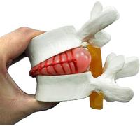 ININOSNP Modello di Anatomia Umana Modello di Colonna vertebrale Modello di dimostrazione di ernia del Disco Lombare Modello di ernia del Disco Lombare Anatomia Umana Malattia degenerativa Lombare