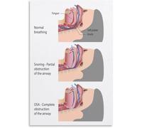 ITCLEYMDZV Sleep Apnea Awareness Poster Understanding Symptoms Causes Wall-Art Canvas Print for Living Room Bedroom Decor(Framed,08x12inch(20x30cm))