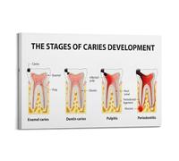 KCDFDVJFBM Oral Health Education Poster - Tooth Decay Development Stages Diagram, Clinic Office Wall-Art & Learning Chart(Framed,12x18inch(30x45cm))