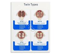 KCDFDVJFBM Twin Pregnancy Placenta Formation Informative Chart Poster Obstetrics Anatomy Wall-Art Canvas for Education Home Decor Living Room Bedroom(Unframed,16x24inch(40x60cm))