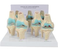 Kit for ginocchio Modello anatomico for osteoartrite, Modello anatomico for patologia dell'articolazione del ginocchio a 4 stadi con base, Strumento didattico medico for la visualizzazione