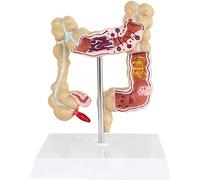LBYLYH Il Modello Patologico di Colon Umano 3D - Lesioni Modello di Colon Modello Colorettale Malattia Patologica del Colon in On Medical Organizzatori Anatomia Modello
