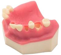 LBYLYH Modello Dentale, Modello di Denti per Esercitazione Dentale Modello Mascella Inferiore Typodont con Gengiva, Denti Superiori per Overdenture 4 Impianti Demo