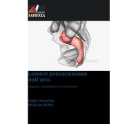 Lesioni precancerose dell'ano: Diagnosi, trattamento e prevenzione