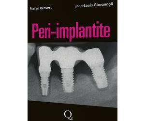 Libri Stefan Renvert - Peri-implantite - 2014