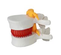 LIXSAZSE Strumento didattico per disco lombare con ernia anatomica Ampia applicazione nella formazione medica Modello efficace di vertebre lombari