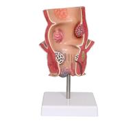 LKYLVEE Modello di Patologia dell'Acne Anorettale - Modello Didattico Medico Emorroidi - Modello Anatomico Intestinale Rettale,A,14CM