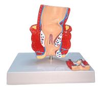 LKYLVEE Modello di Patologia dell'Acne Anorettale - Modello Didattico Medico Emorroidi - Modello Anatomico Intestinale Rettale,B,14CM