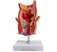 LKYLVEE Modello di Patologia Rettale Umana - Modello Anatomico di Lesioni Rettali - Organi Viscerali per Chirurgia del Colon e del Retto per Insegnamento e Esposizione,Flesh,20CM