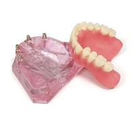 LKYLVEE Modello dimostrativo di 4 impianti per Denti Superiori per overdenture - Modello di impianto per Denti Trasparenti - Modello di localizzazione di impianti Modello,Clear,7cm