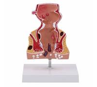 LKYLVEE Modello Umano di Emorroidi Rettali - Modello di Patologia Colica - Strumento Didattico per Chirurgia Anorettale,Rosso,22CM