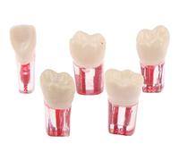Lpitoy 5 Pz Resina Dentale Endodonzia Dente Modello Endo Canalare Lime Polpa Pratica Endo Formazione Dente RCT Demo Studente Insegnamento