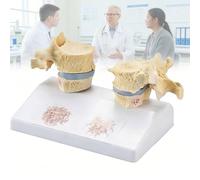 Mavdecll Confronta Le Vertebre Toraciche Osteoporotiche con Quelle Normali, Il Modello di Lesione Dell'osteoporosi Dell'osso Umano, Il Modello delle Vertebre Dell'osteoporosi