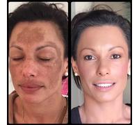 MEDERMA ADVANCED PLUS SCAR GEL PER CICATRICI E MARCHI - No1 - Spedizione...
