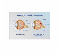 Medical Education Poster Diabetic Retinopathy Chart Eye Condition Diagram for Health Clinic Classroom Training Room Decor(Unframed,12x18inch(30x45cm))