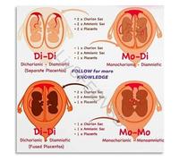 Medical Office Decor Canvas Wall Art Twin Pregnancy Placentation Process Detailed Anatomy Chart for Clinic Home Decor(Framed,08x12inch(20x30cm))