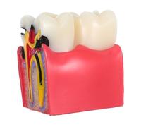 Mikinona Modello Didattico per Carie con Sezione Ingrandita Strumento di Anatomia e Confronto Denti Sani e Cariati per Educatori Cliniche e Studenti