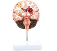 Modello 1:1 di malattia cerebrale nell'uomo Modello anatomico del cervello Neurochirurgia Emorragia cerebrale Insegnamento medico patologico del cervello