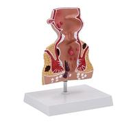 Modello 1,5X del retto umano con patologie comuni, modello anatomico della lesione rettale, sussidi didattici for la patologia delle fessure della fistola, materiale in PVC