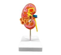 Modello anatomico 4D del rene umano Modello anatomico Modello didattico Organi umani Modello di rene malato Modello del corpo umano Modello di rene Educazione Educare