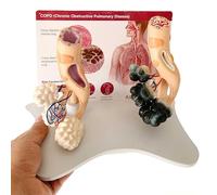 Modello anatomico alveolare umano, visualizzazione comparativa del fumo rispetto agli alveoli sani, struttura allargata per una migliore educazione sanitaria