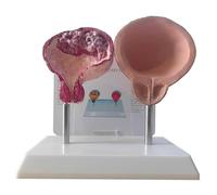 Modello Anatomico Comparativo della Vescica Sana con Caratteristiche Patologiche Dettagliate, Struttura Accurata per l'Educazione Medica e Le Dimostrazioni Didattiche