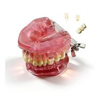Modello anatomico con denti rimovibili, modello di impianto dentale, modello di tipodonto dentale con 28 denti staccabili per scopi didattici.(pink)