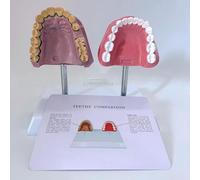 Modello anatomico dei denti dell'apparato orale umano, modello comparativo tra denti sani e denti da fumo, con struttura anatomica accurata e caratteristiche patologiche for studenti di odontoiatria