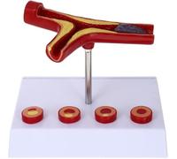 Modello anatomico dei vasi sanguigni umani, modello di arteriosclerosi cardiovascolare, modello di aterosclerosi, modello di trombosi umana for esposizione didattica medica.