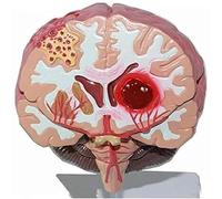Modello anatomico del cervello, modello di ictus, modello patologico di emorragia cerebrale, malformazione arterovenosa cerebrale, modello di struttura cerebrale 1:1, sussidio didattico medico