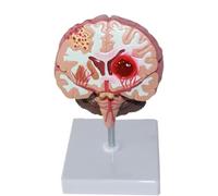 Modello Anatomico Del Cervello Umano, Modello Di Lesione Dei Vasi Sanguigni Cerebrali E Della Struttura Cerebrale, Modello Di Ictus In PVC, Modello Patologico Di Emorragia Cerebrale E Malformazione