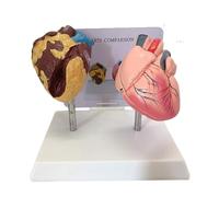 Modello anatomico del cuore fumatore vs. normale, set di visualizzazione comparativo delle malattie cardiache con strumento didattico medico di base Apprendimento Dissezione