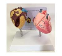 Modello anatomico del cuore umano: un confronto tra il cuore di un fumatore e un cuore normale, progettato per scopi di studio medico, visualizzazione e insegnamento.