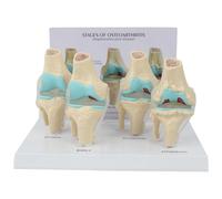 Modello Anatomico Del Ginocchio Per L'Osteoartrite Con Scheda Didattica A 4 Fasi